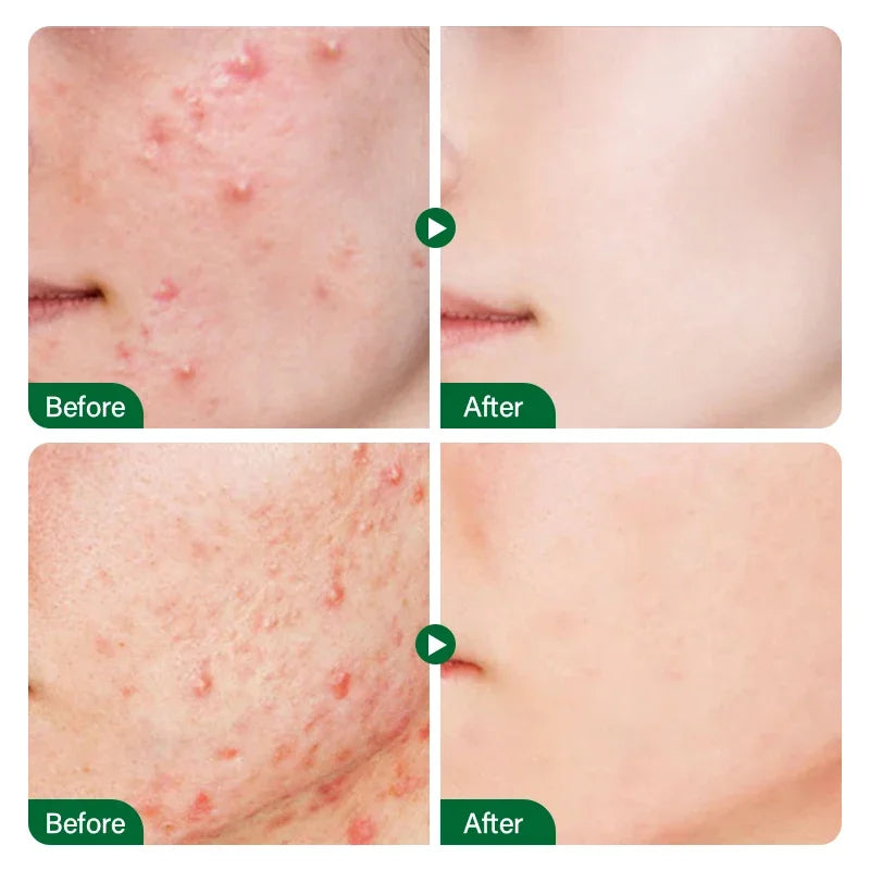 Salicylic Acid Acne Treatment Cream Repair Pimple Spots Serum Cleaning Pore Anti-acne Oil Control Moisturizer Smooth Skin Care - Jamboshop.com