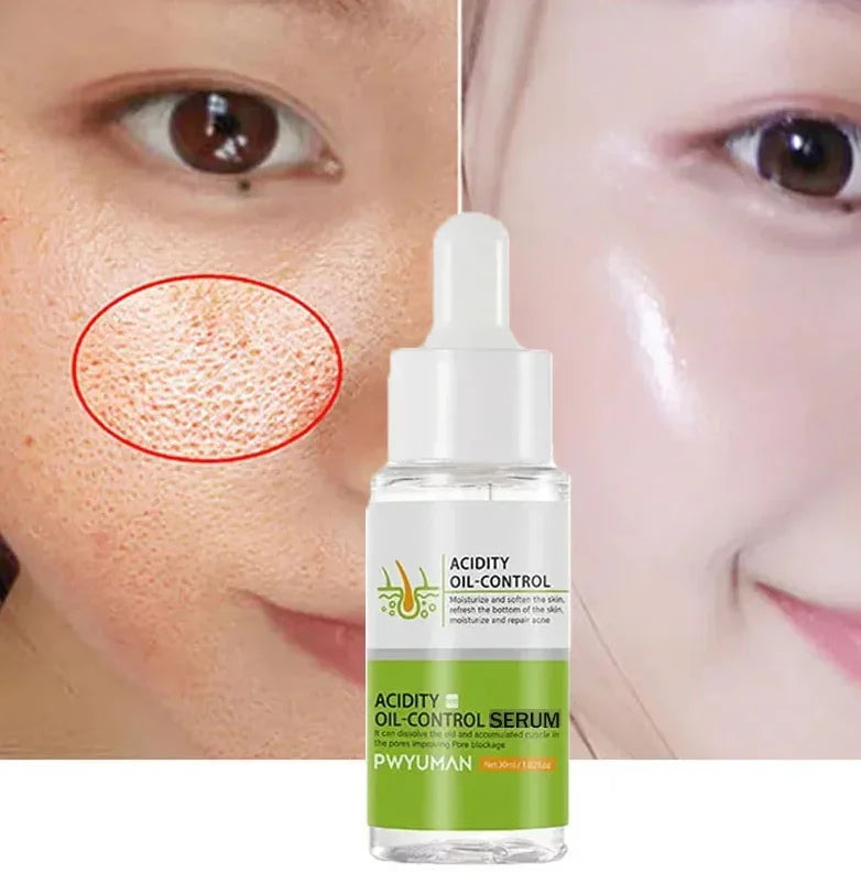 Salicylic Acid Acne Treatment Cream Repair Pimple Spots Serum Cleaning Pore Anti-acne Oil Control Moisturizer Smooth Skin Care - Jamboshop.com