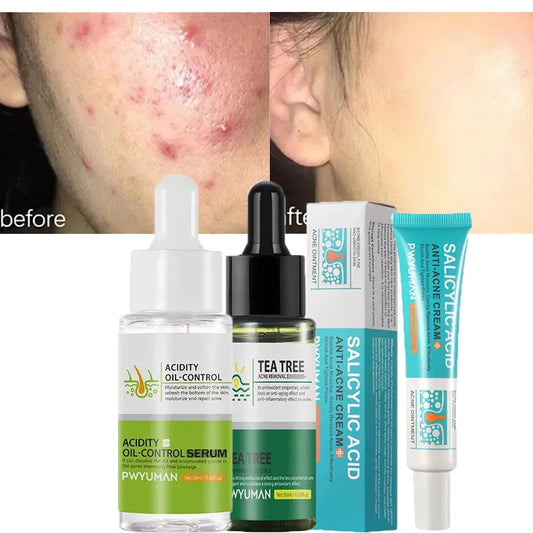 Salicylic Acid Acne Treatment Cream Repair Pimple Spots Serum Cleaning Pore Anti-acne Oil Control Moisturizer Smooth Skin Care - Jamboshop.com