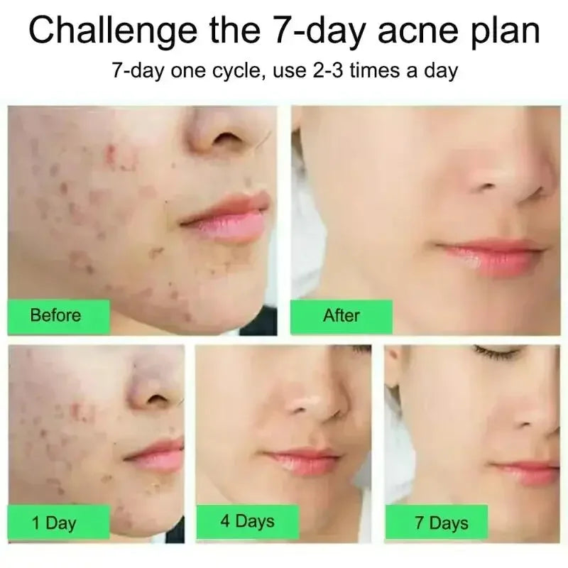 Salicylic Acid Acne Treatment Cream Repair Pimple Spots Serum Cleaning Pore Anti-acne Oil Control Moisturizer Smooth Skin Care - Jamboshop.com