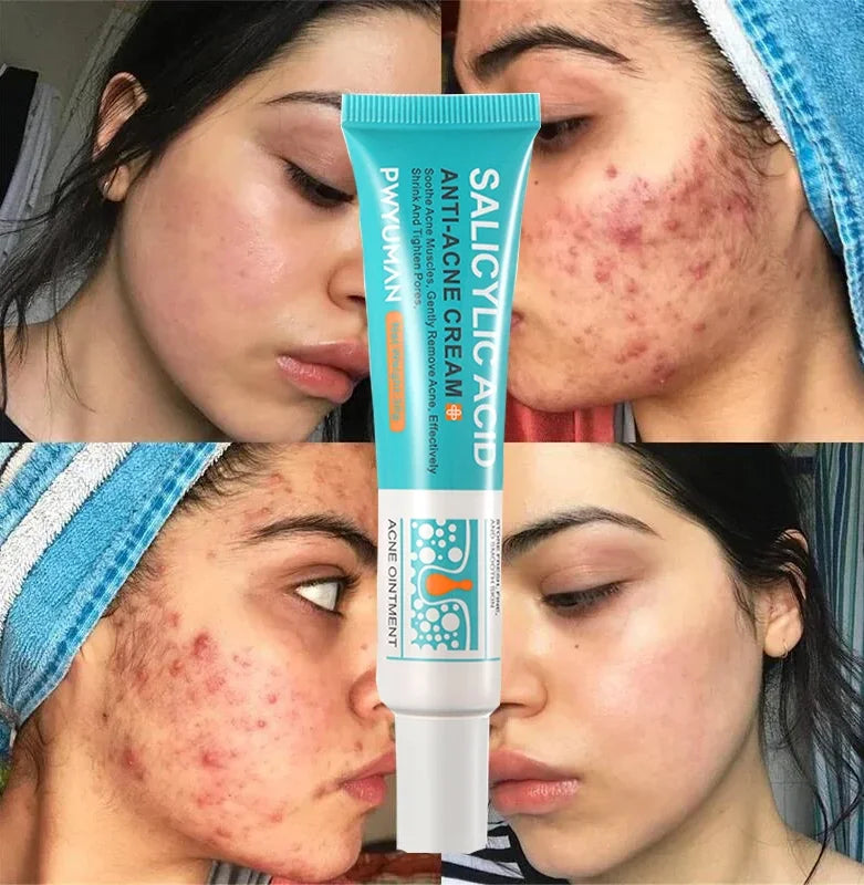 Salicylic Acid Acne Treatment Cream Repair Pimple Spots Serum Cleaning Pore Anti-acne Oil Control Moisturizer Smooth Skin Care - Jamboshop.com