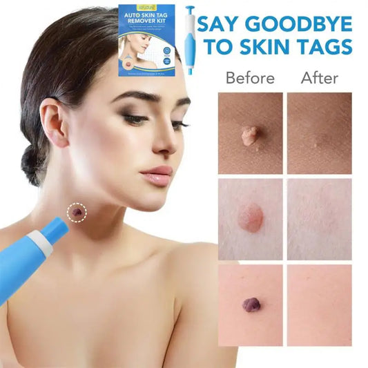 2 In1 Painless Auto Skin Tag Mole Removal Kit Cleaning Tools Face Skin Care Body Dot Treatments Remover Beauty Health